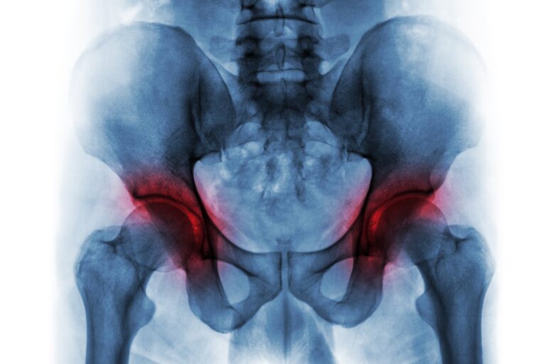 Can I get Social Security Disability for my avascular necrosis of the hip?