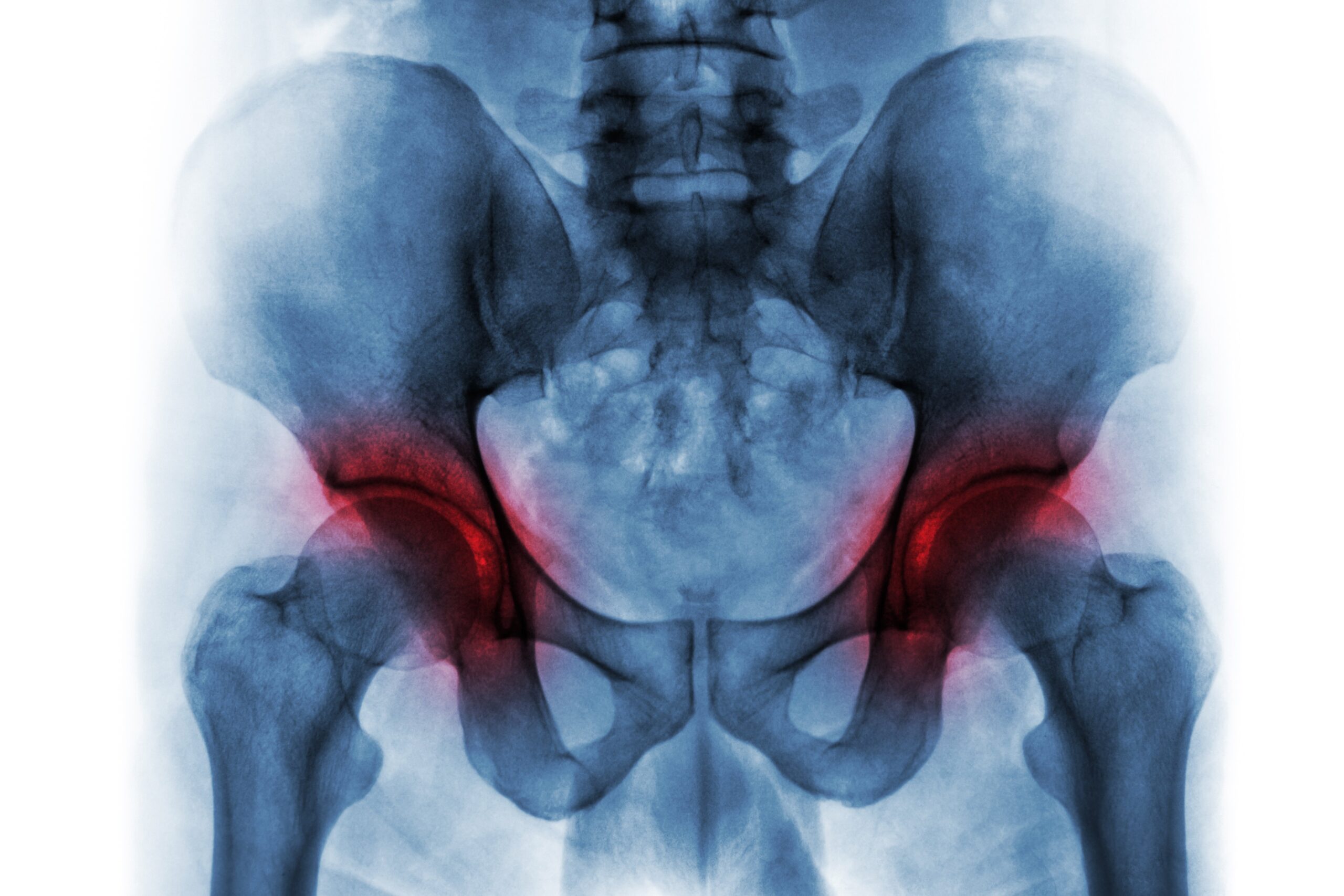 Can I get Social Security Disability for my avascular necrosis of the hip?
