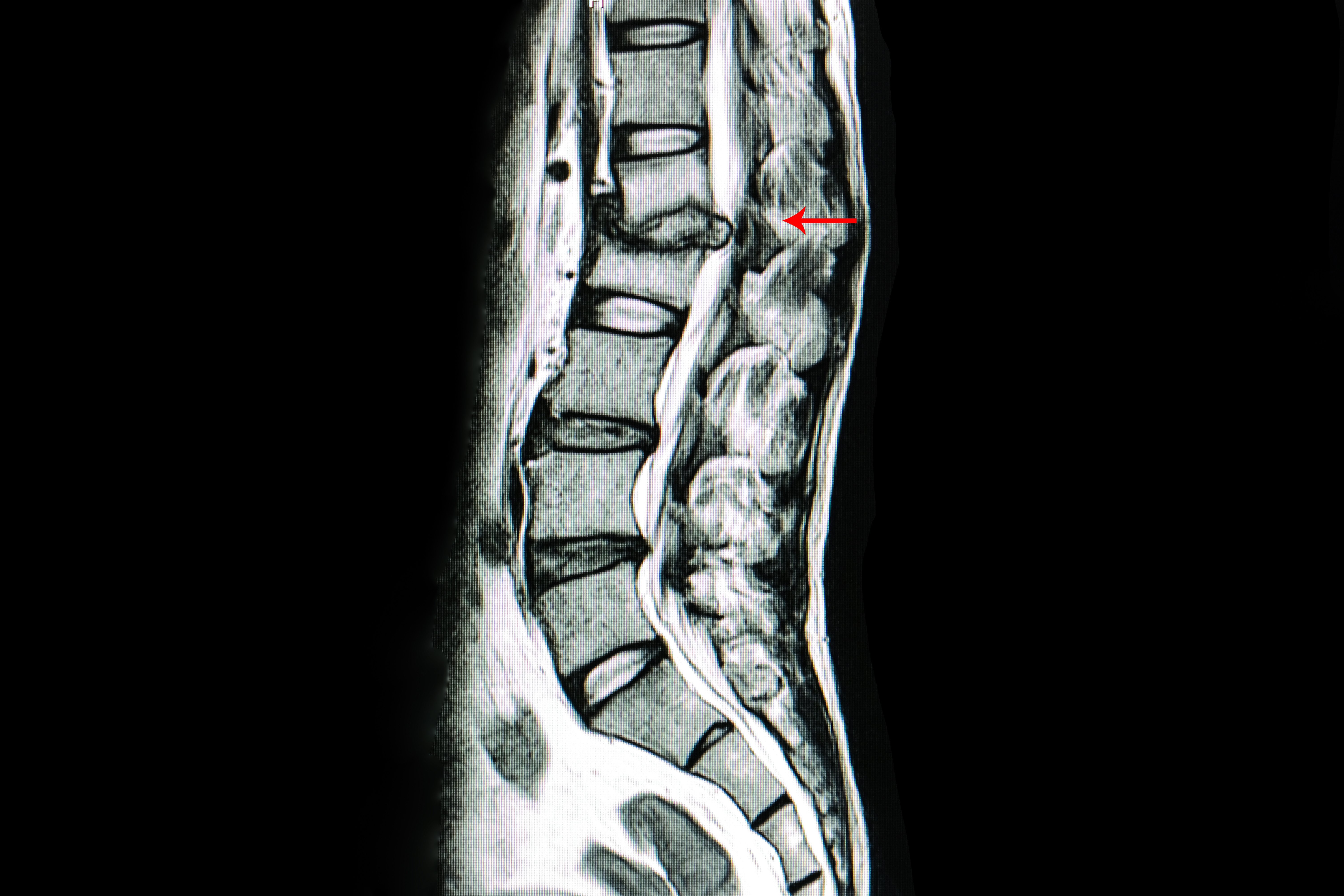 Can I get Social Security Disability for my Degenerative Disc Disease?