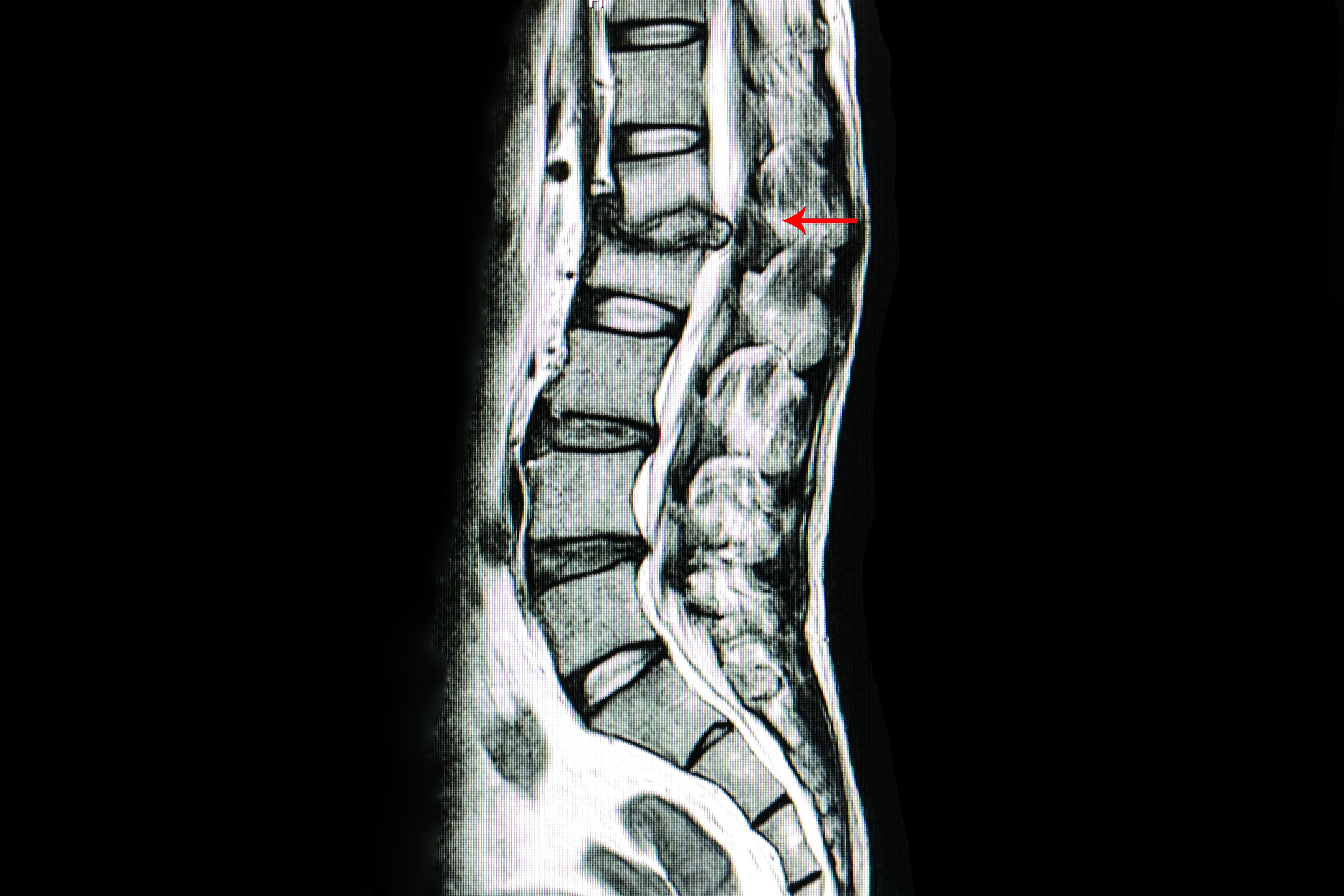 can-i-get-social-security-disability-for-my-degenerative-disc-disease