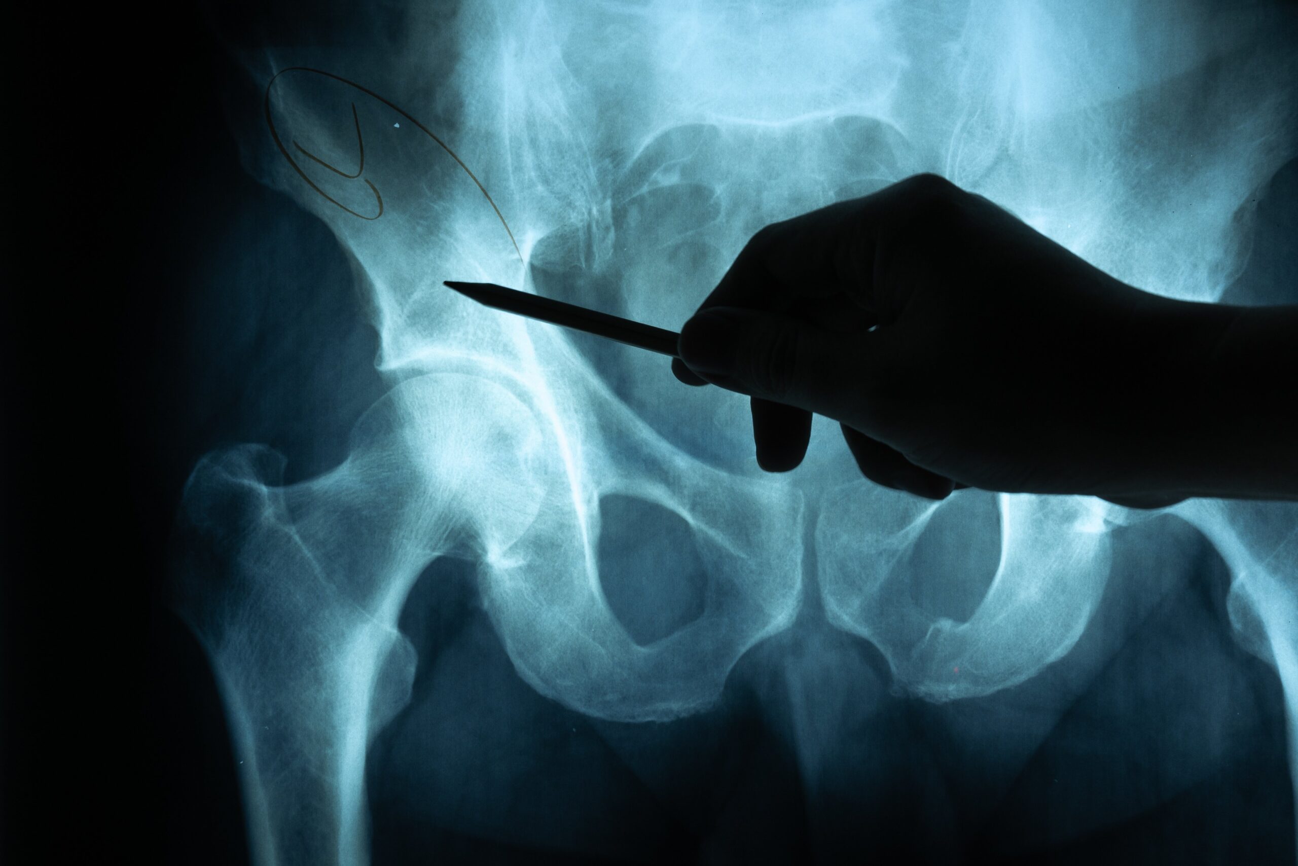 Can I get Social Security Disability for my broken hip?