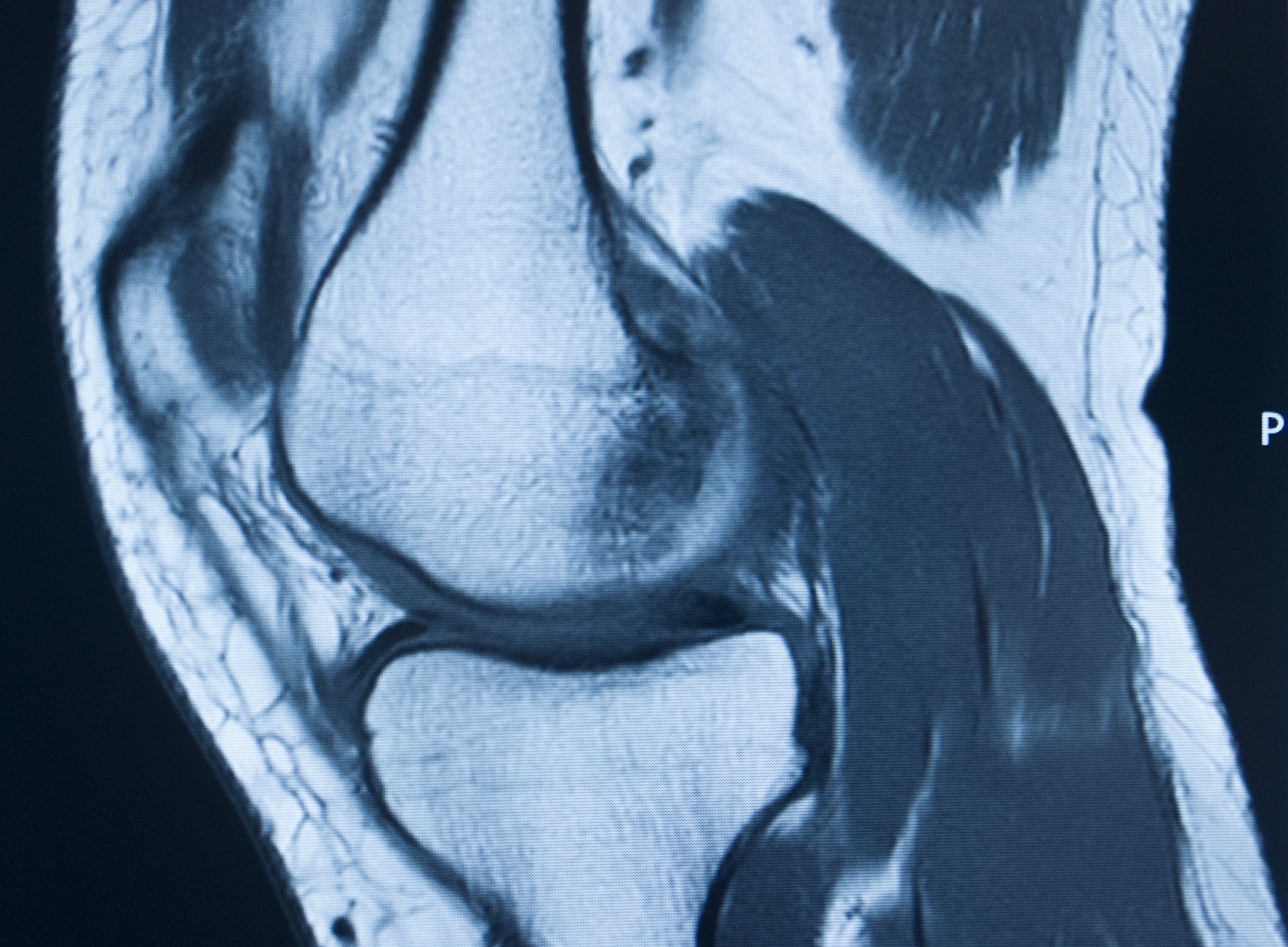 Can I get Social Security Disability for my medial cruciate ligament (MCL) tear?