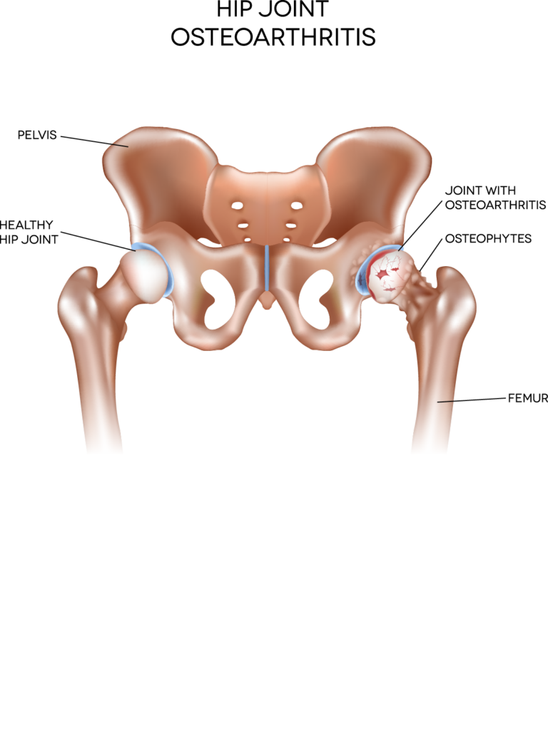 Can I get Social Security Disability for my hip arthritis?