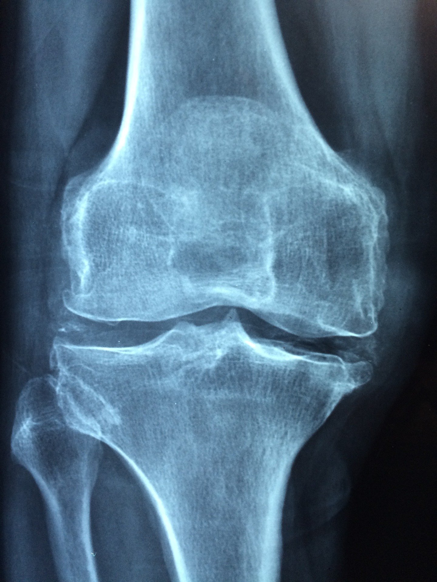 Can I get Social Security Disability for my rheumatoid arthritis of the knee?