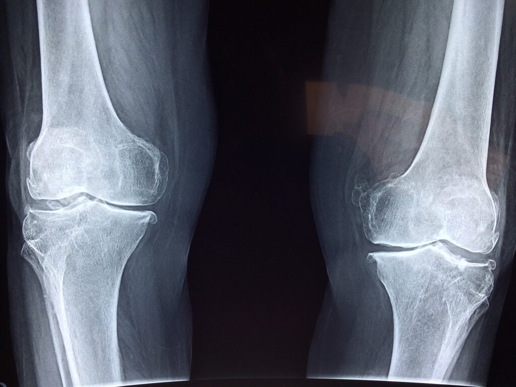 Can I get Social Security Disability for my osteoarthritis of the knee