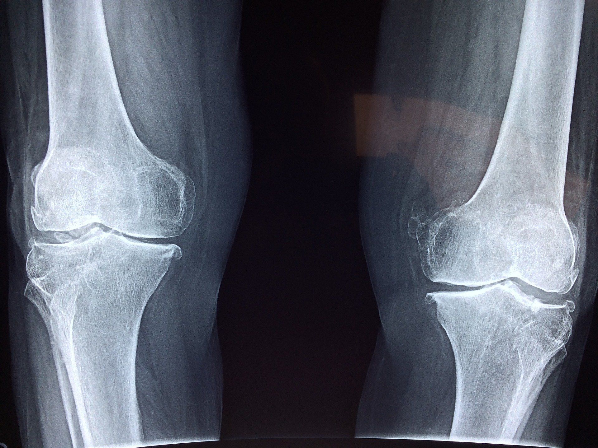 Can I get Social Security Disability for my osteoarthritis of the knee?