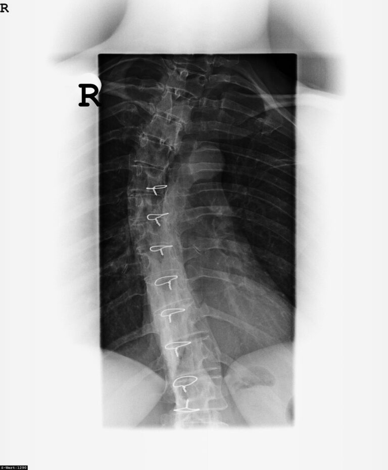 Can I get Social Security Disability for my herniated disc?