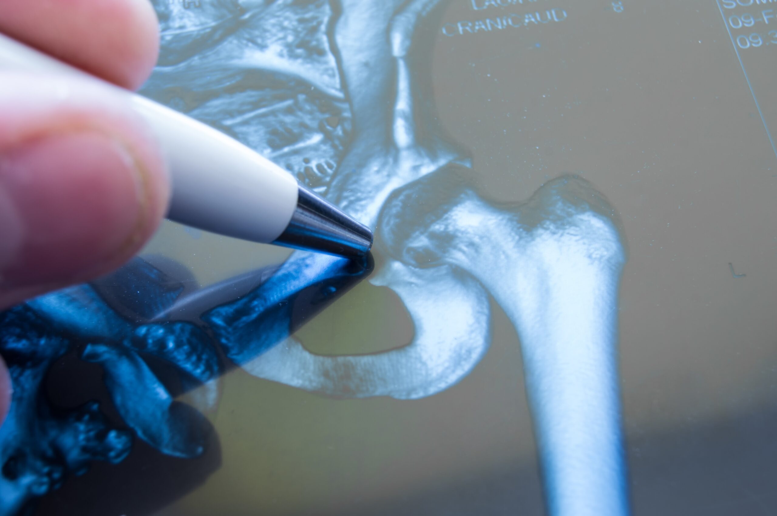 Can I get Social Security Disability for my hip fracture?