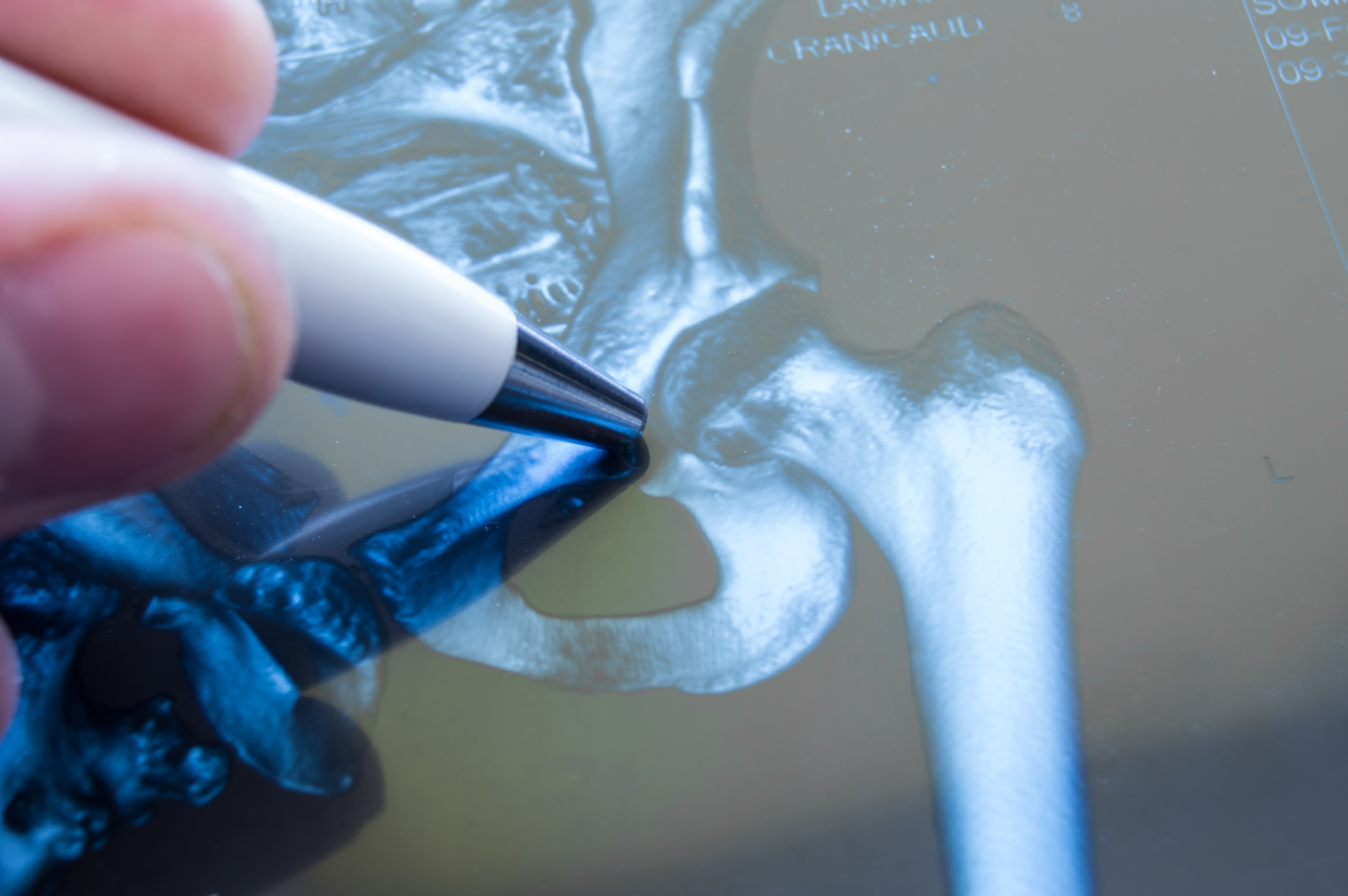 Can I get Social Security Disability for my hip fracture?